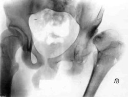 Congenital dislocation of left hip.