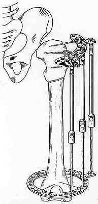 Schanz-Ilisarov's operation with elongation of hip.